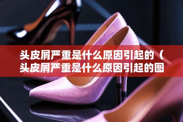 头皮屑严重是什么原因引起的（头皮屑严重是什么原因引起的图片）